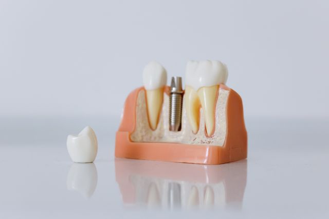 Implants dentaires