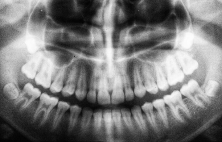 atm et implants dentaires