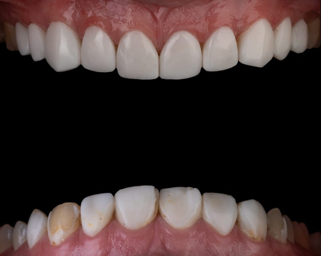 Couronnes ou implants ?