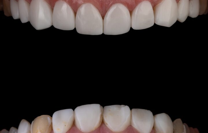 Couronnes ou implants ?