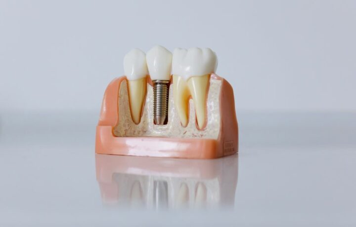 IMPLANTS DENTAIRES