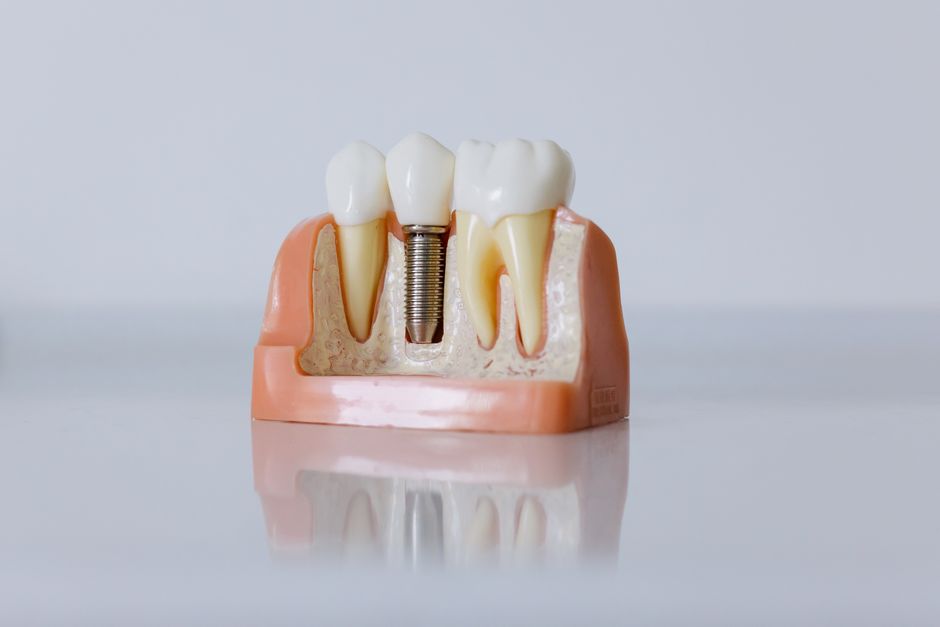IMPLANTS DENTAIRES